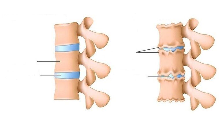 colonna vertebrale sana e colonna vertebrale colpita da osteocondrosi