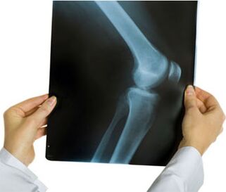 Radiografia dell'artrosi del ginocchio