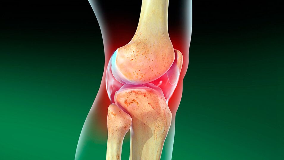 Artrosi dell'articolazione del ginocchio